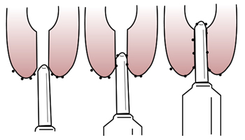 Micro-organismo são reintroduzidos na glândula mamária quando não há prévia desinfecção da ponta do teto